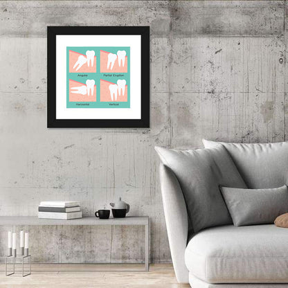 Wisdom Tooth Types Diagram Wall Art